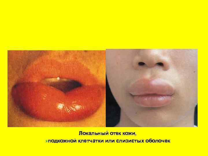 Отек Квинке Локальный отек кожи, Øподкожной клетчатки или слизистых оболочек 