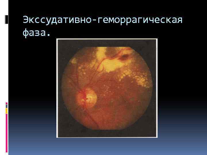 Экссудативно-геморрагическая фаза. 