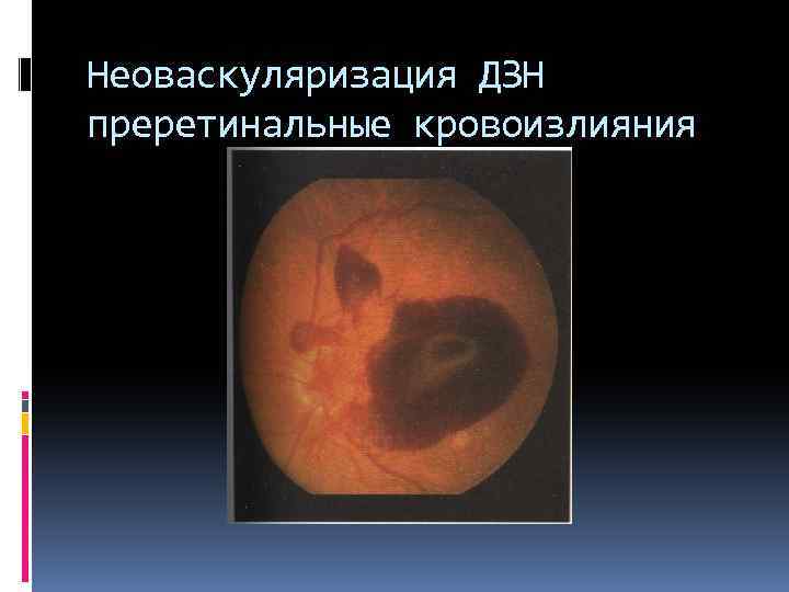 Неоваскуляризация ДЗН преретинальные кровоизлияния 