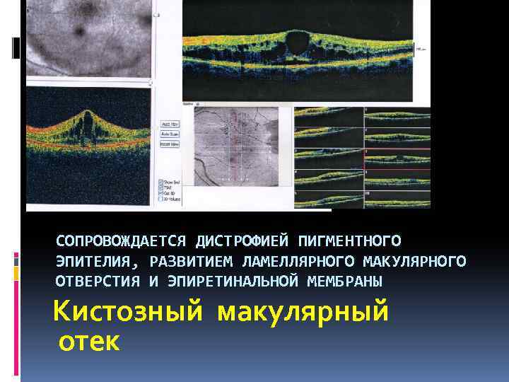 СОПРОВОЖДАЕТСЯ ДИСТРОФИЕЙ ПИГМЕНТНОГО ЭПИТЕЛИЯ, РАЗВИТИЕМ ЛАМЕЛЛЯРНОГО МАКУЛЯРНОГО ОТВЕРСТИЯ И ЭПИРЕТИНАЛЬНОЙ МЕМБРАНЫ Кистозный макулярный отек