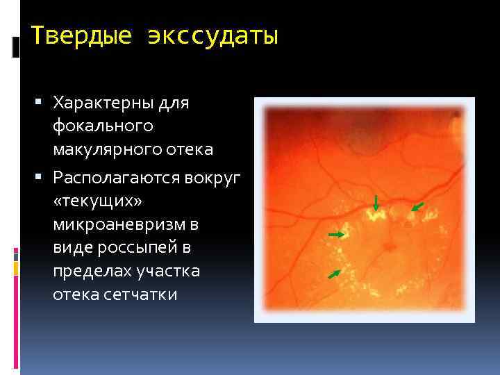 Твердые экссудаты Характерны для фокального макулярного отека Располагаются вокруг «текущих» микроаневризм в виде россыпей