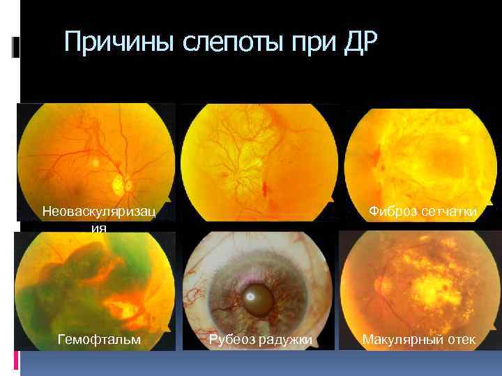 Причины слепоты при ДР Неоваскуляризац ия Гемофтальм Фиброз сетчатки Рубеоз радужки Макулярный отек 