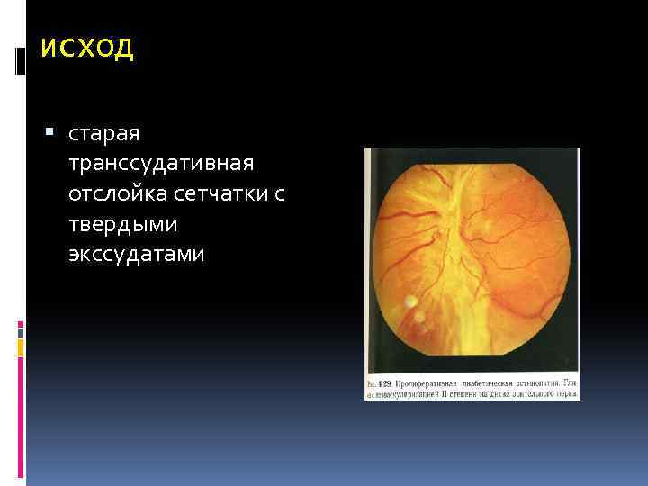 исход старая транссудативная отслойка сетчатки с твердыми экссудатами 