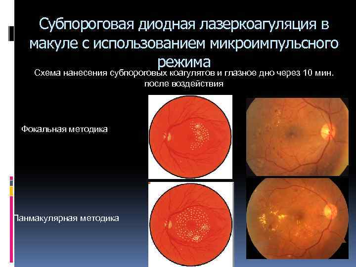 Субпороговая диодная лазеркоагуляция в макуле с использованием микроимпульсного режима Схема нанесения субпороговых коагулятов и