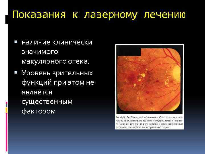 Показания к лазерному лечению наличие клинически значимого макулярного отека. Уровень зрительных функций при этом