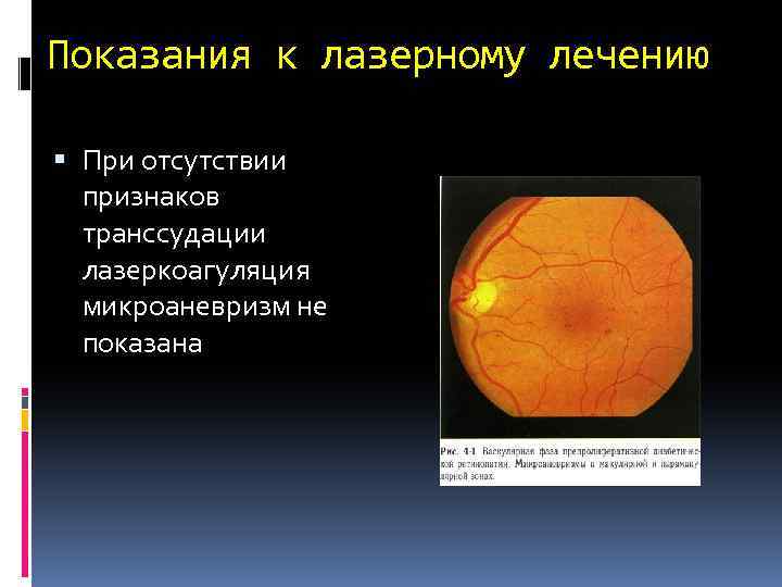 Показания к лазерному лечению При отсутствии признаков транссудации лазеркоагуляция микроаневризм не показана 