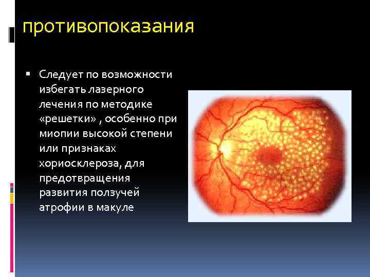 противопоказания Следует по возможности избегать лазерного лечения по методике «решетки» , особенно при миопии