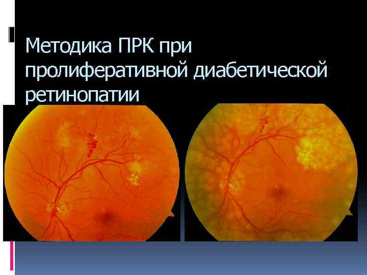 Методика ПРК при пролиферативной диабетической ретинопатии 