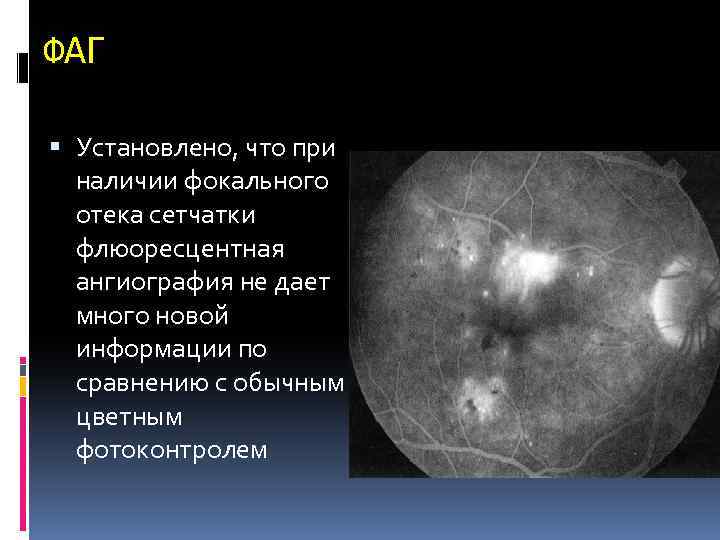 ФАГ Установлено, что при наличии фокального отека сетчатки флюоресцентная ангиография не дает много новой