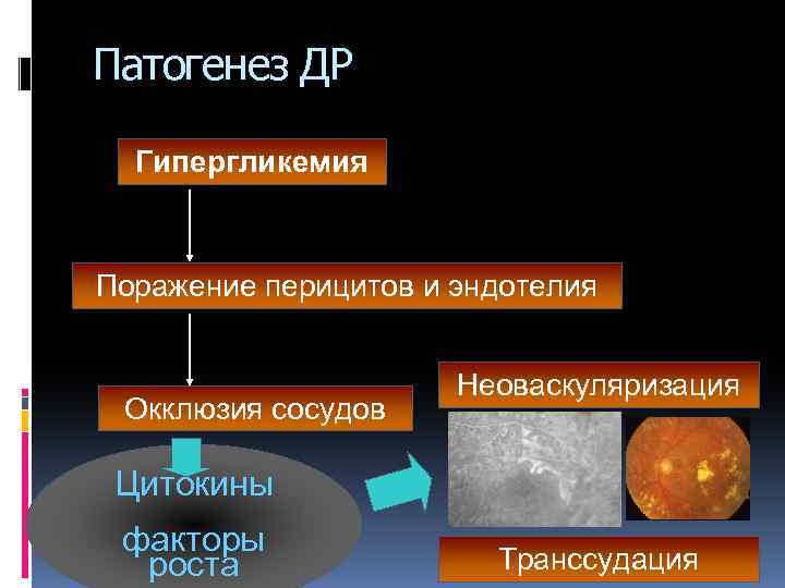 Патогенез ДР Гипергликемия Поражение перицитов и эндотелия Окклюзия сосудов Неоваскуляризация Цитокины факторы роста Транссудация