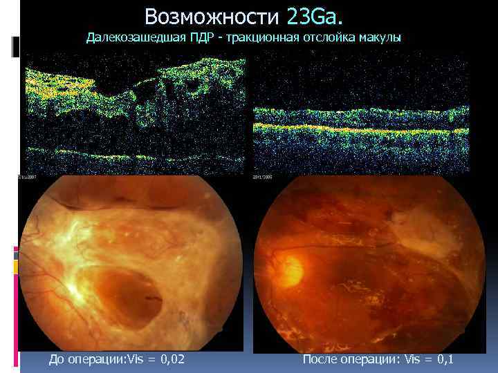 Возможности 23 Ga. Далекозашедшая ПДР - тракционная отслойка макулы До операции: Vis = 0,