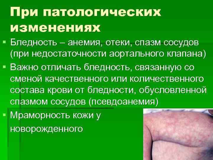 При патологических изменениях § Бледность – анемия, отеки, спазм сосудов (при недостаточности аортального клапана)