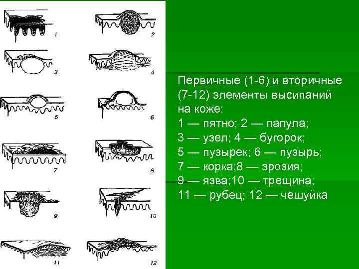 Первичные и вторичные морфологические элементы кожи презентация