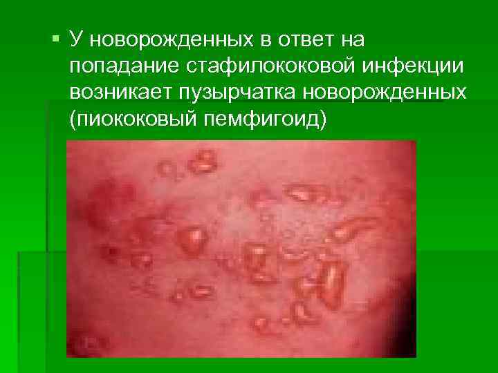 § У новорожденных в ответ на попадание стафилококовой инфекции возникает пузырчатка новорожденных (пиококовый пемфигоид)