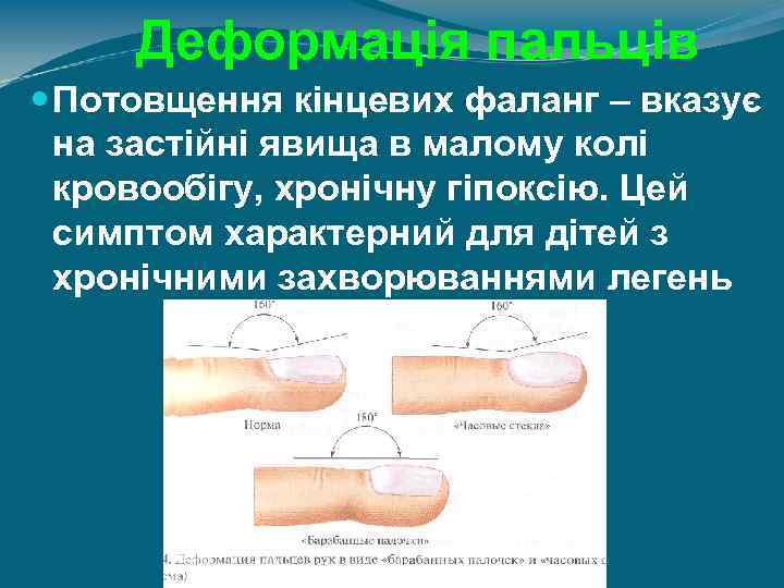 Деформація пальців Потовщення кінцевих фаланг – вказує на застійні явища в малому колі кровообігу,