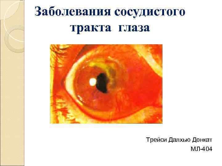 Заболевания сосудистого тракта глаза Трейси Далхью Донкат МЛ-404 