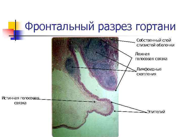 Фронтальный разрез гортани Собственный слой слизистой оболочки Ложная голосовая связка Лимфоидные скопления Истинная голосовая