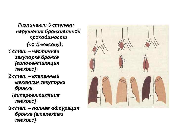 Различают 3 степени нарушения бронхиальной проходимости (по Джексону): 1 степ. – частичная закупорка бронха