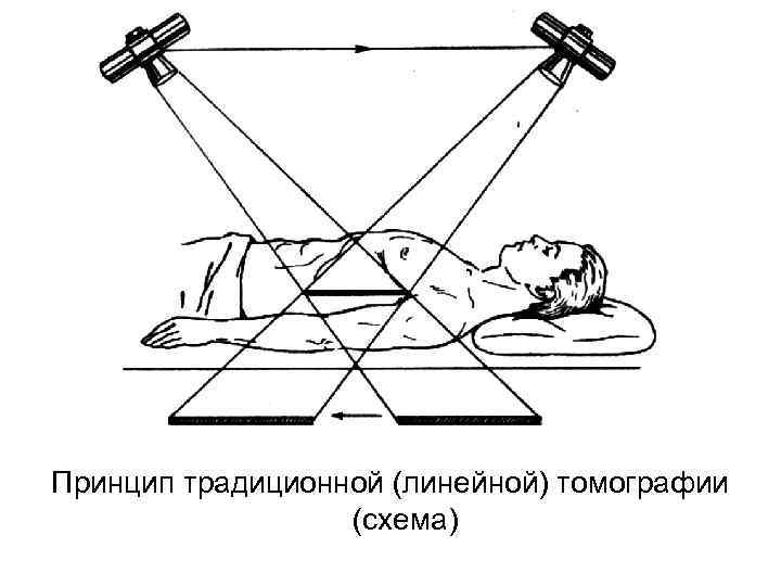 Принцип традиционной (линейной) томографии (схема) 