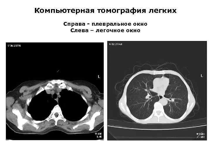 Компьютерная томография легких Справа - плевральное окно Слева – легочное окно 