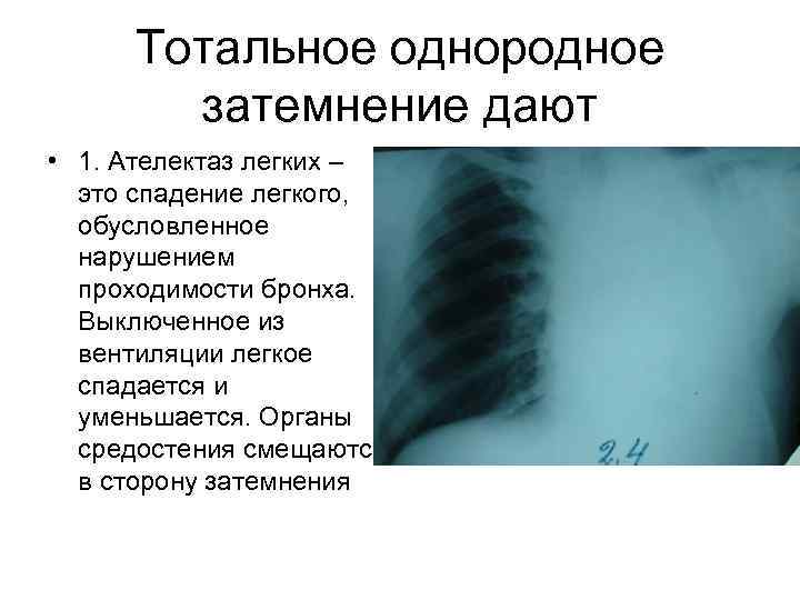 Тотальное однородное затемнение дают • 1. Ателектаз легких – это спадение легкого, обусловленное нарушением