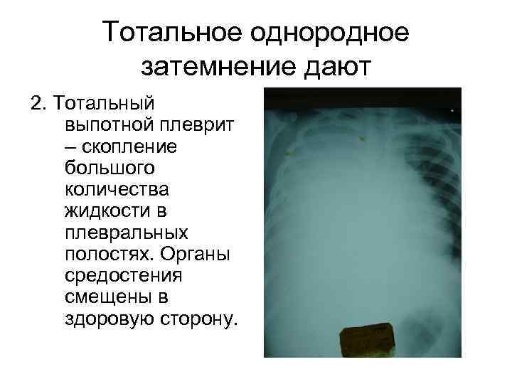 Тотальное однородное затемнение дают 2. Тотальный выпотной плеврит – скопление большого количества жидкости в