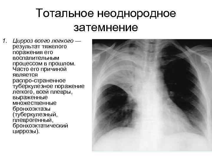 Тотальное неоднородное затемнение 1. Цирроз всего легкого — результат тяжелого поражения его воспалительным процессом