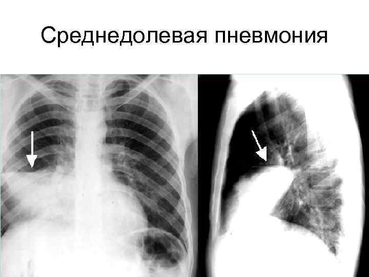 Среднедолевая пневмония 