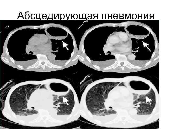 Абсцедирующая пневмония 