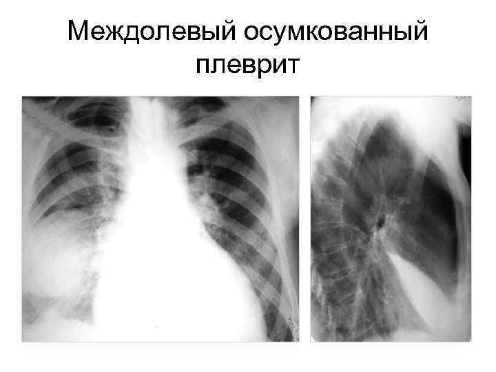 Междолевый осумкованный плеврит 