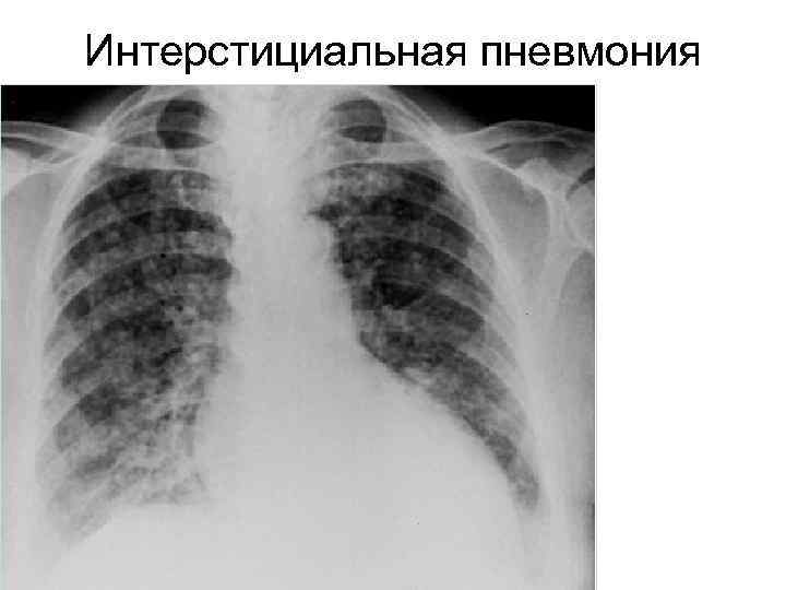 Интерстициальная пневмония 