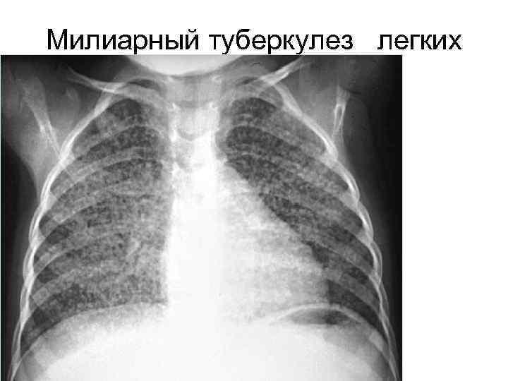 Милиарный туберкулез легких 