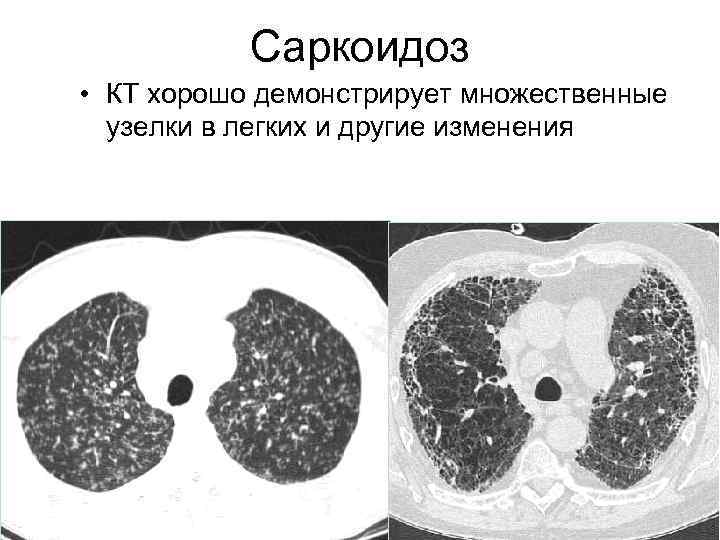 Саркоидоз • КТ хорошо демонстрирует множественные узелки в легких и другие изменения 