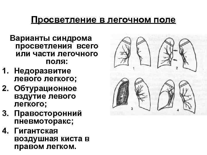 Просветление в легочном поле Варианты синдрома просветления всего или части легочного поля: 1. Недоразвитие