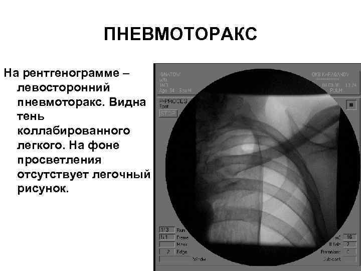 ПНЕВМОТОРАКС На рентгенограмме – левосторонний пневмоторакс. Видна тень коллабированного легкого. На фоне просветления отсутствует