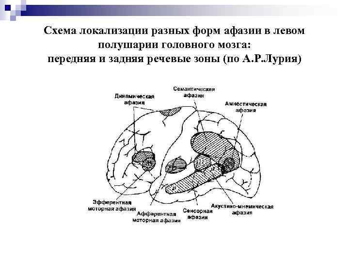 Нарушение артикуляционных схем отдельных звуков является первичным дефектом при пусто афазии