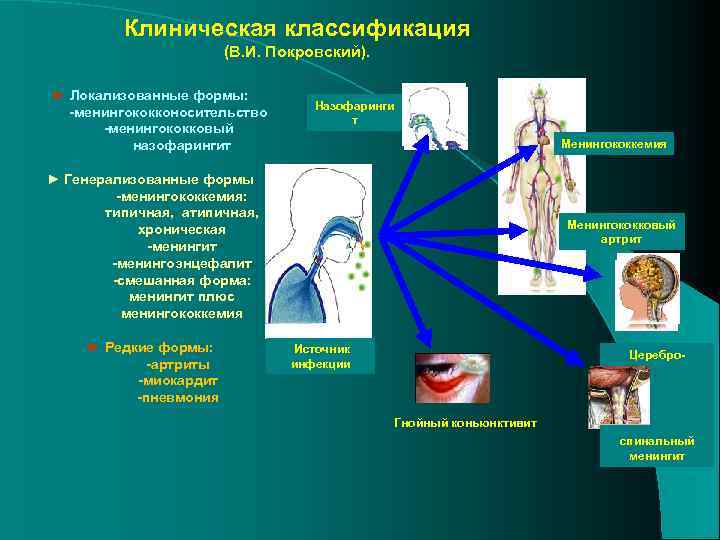 Клиническая классификация (В. И. Покровский). ► Локализованные формы: -менингококконосительство -менингококковый назофарингит Назофаринги т Менингококкемия
