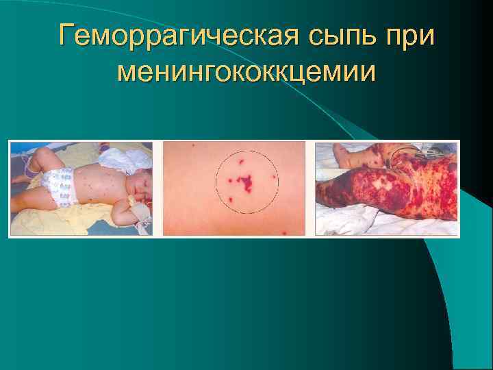Геморрагическая сыпь при менингококкцемии 