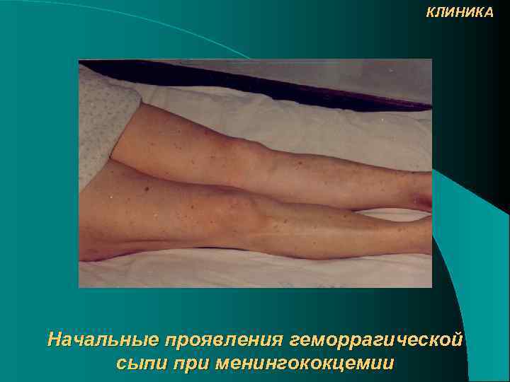 КЛИНИКА Начальные проявления геморрагической сыпи при менингококцемии 