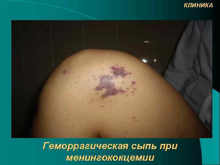 КЛИНИКА Геморрагическая сыпь при менингококцемии 