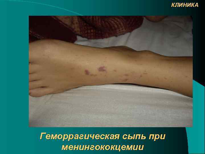 КЛИНИКА Геморрагическая сыпь при менингококцемии 