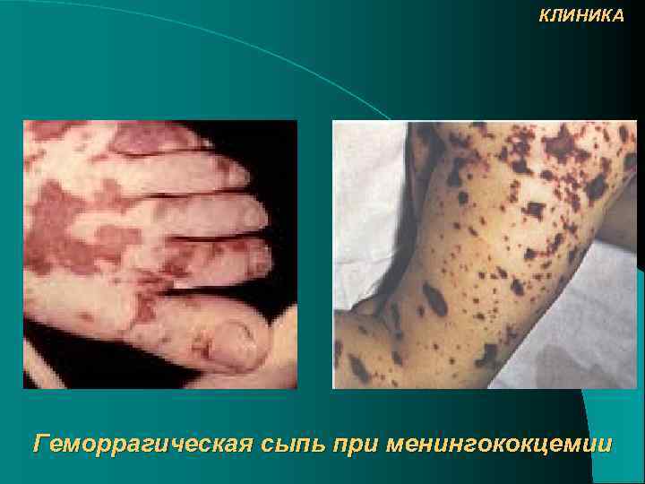 КЛИНИКА Геморрагическая сыпь при менингококцемии 