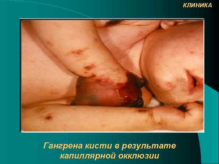 КЛИНИКА Гангрена кисти в результате капиллярной окклюзии 