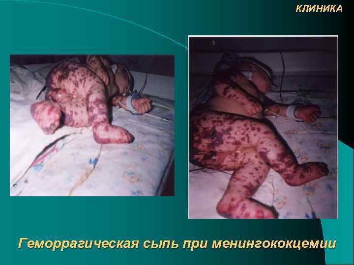 КЛИНИКА Геморрагическая сыпь при менингококцемии 