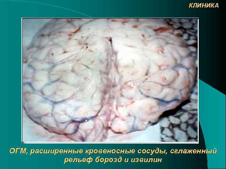 КЛИНИКА ОГМ, расширенные кровеносные сосуды, сглаженный рельеф борозд и извилин 