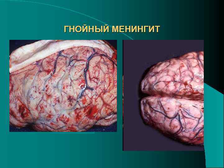 ГНОЙНЫЙ МЕНИНГИТ ОСНОВАНИЕ МОЗГА ПОЛУШАРИЯ МОЗГА 
