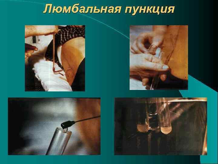 Люмбальная пункция 