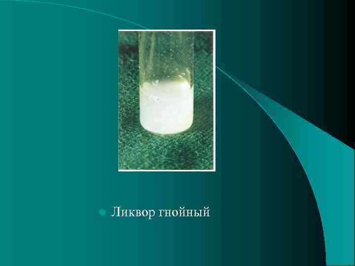 l Ликвор гнойный 