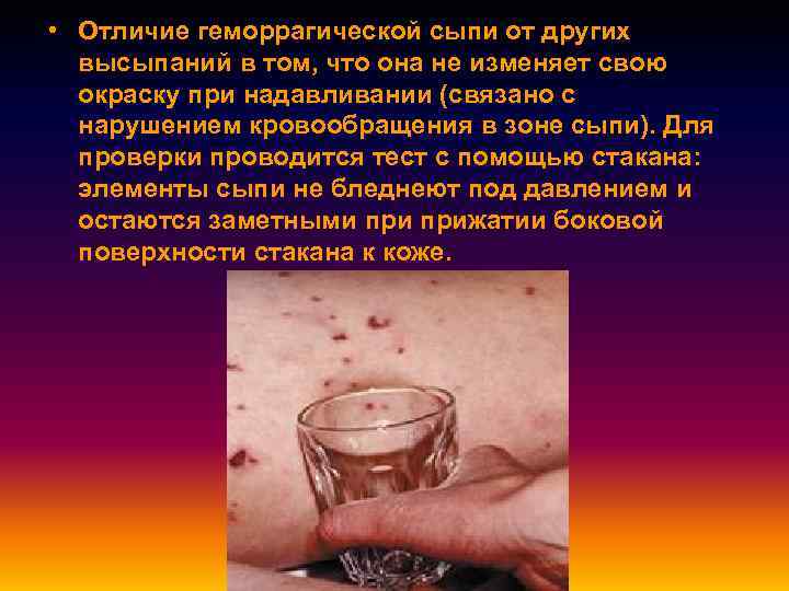  • Отличие геморрагической сыпи от других высыпаний в том, что она не изменяет