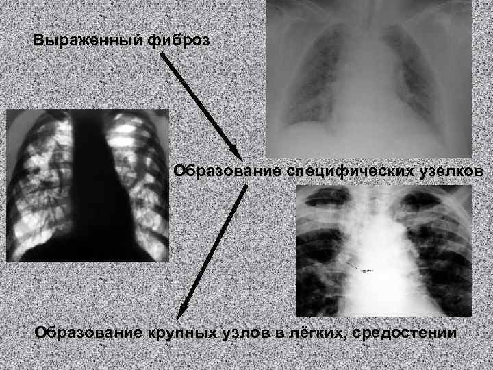 Выраженный фиброз Образование специфических узелков Образование крупных узлов в лёгких, средостении 